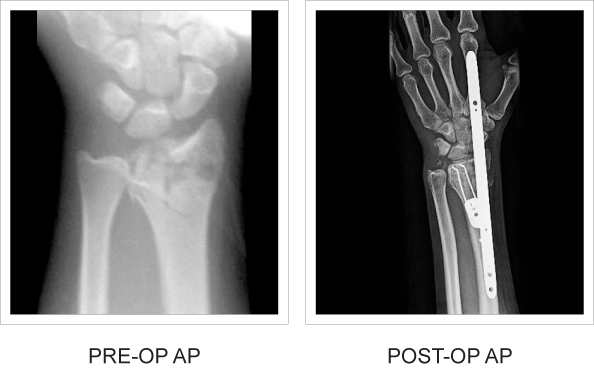 Side-by-side pre and post-op x-rays