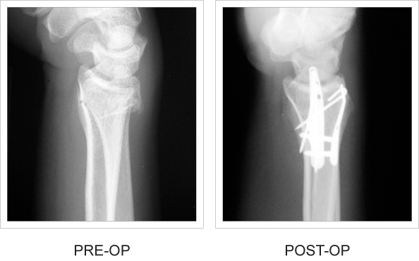 Dorsal Ulnar Pin Plate x-ray comparison pre and post operation