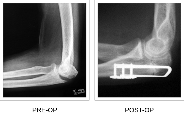X-ray comparison from pre and post-operation