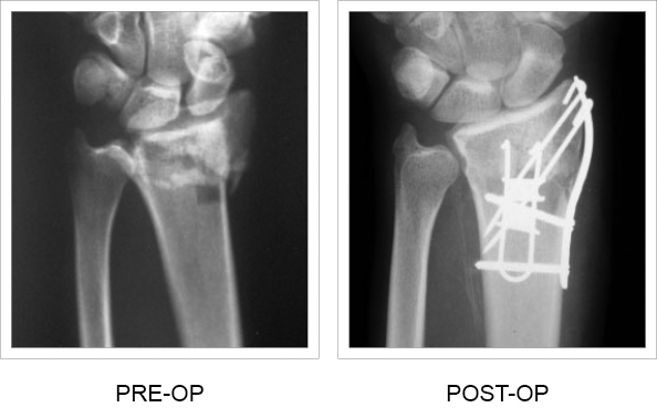 X-ray comparison pre and post-op