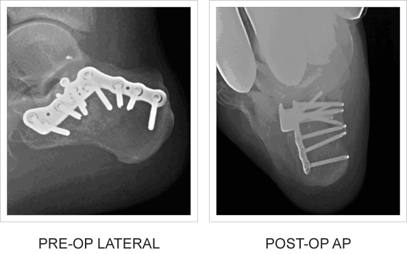 X-ray comparison pre and post operation