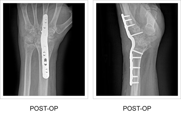 Post-op x-rays of the Total Wrist Fusion Plate