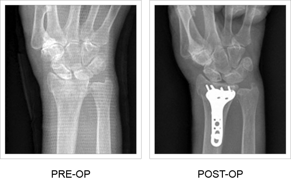 X-rays from before and after implant fixation