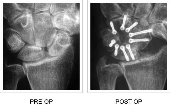 X-rays of the fusion cup pre and post-op
