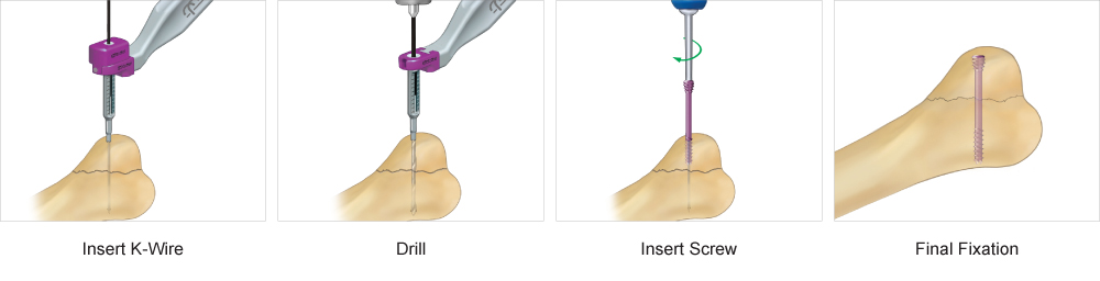 Surgical Technique guide for screw implant system