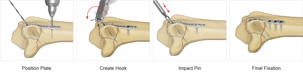 Dorsal Ulnar Pin Plate surgical technique