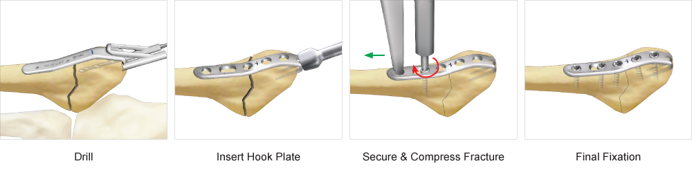 Jones Fracture Plate surgical technique