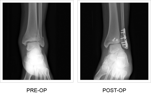 Anterior pre and post-op x-rays of the Ankle Hook Plate