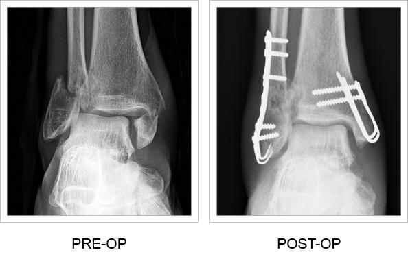 Before and after surgery x-rays of the Medial Malleolar Sled implant