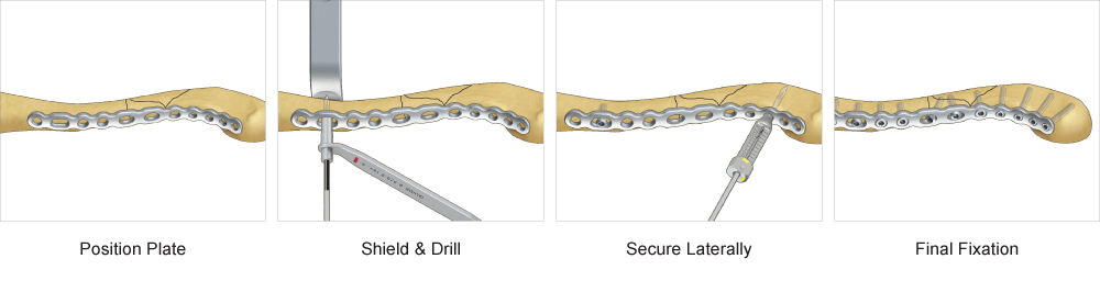 Surgical technique for TriMed's Anterior Clavicle Plate system