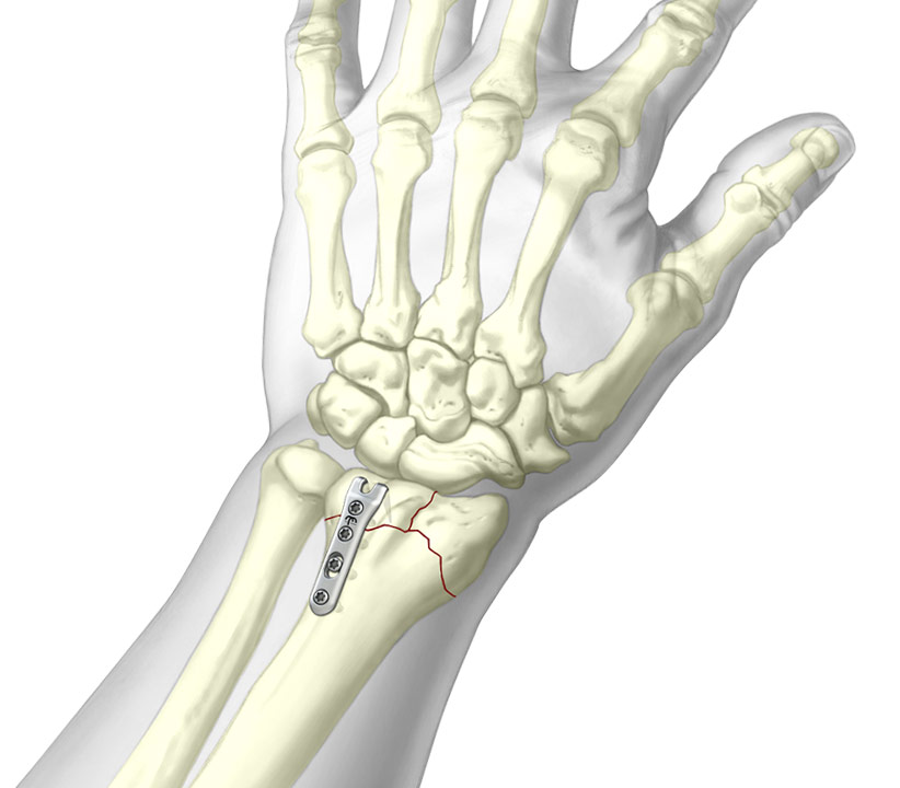 Dorsal Hook Plate wrist fixation system installed onto radial fracture
