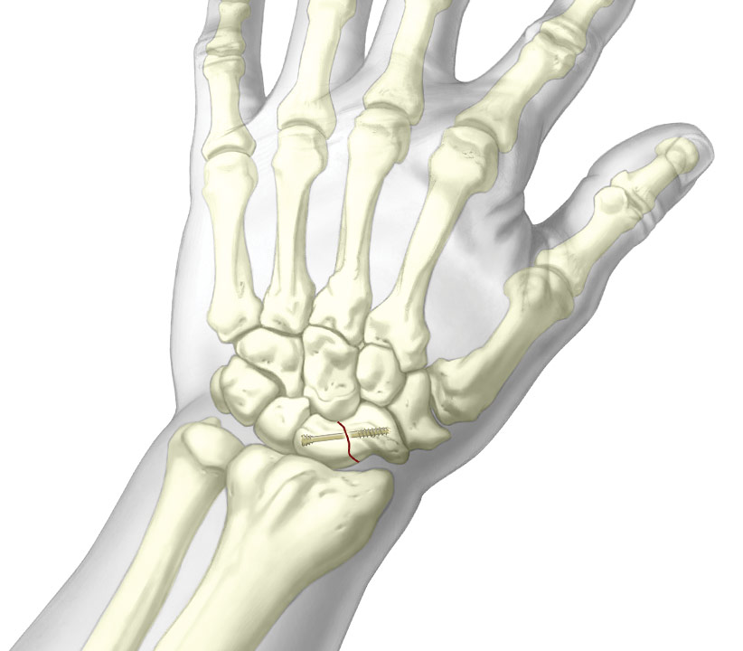 Graphic of scaphoid screw in wrist